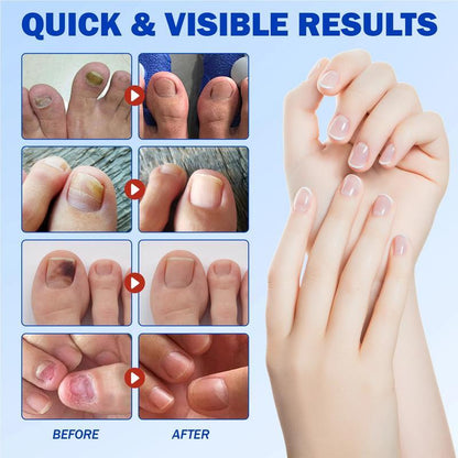 Petluxecos Fungal Nail Repair Patches