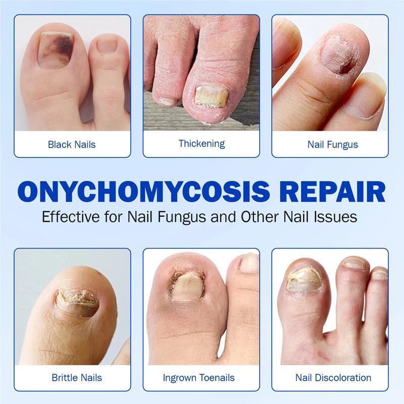 Petluxecos Fungal Nail Repair Patches