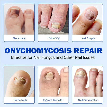 Petluxecos Fungal Nail Repair Patches